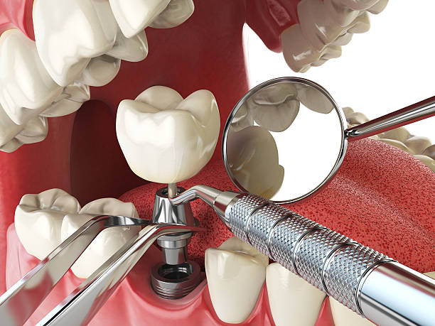 Best Emergency Dental Care for Abscessed Tooth in Morganville, NJ